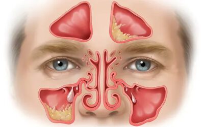 Sinusite Crônica: Causas, Tratamento e Prevenção