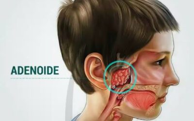 Cirurgia da adenoide e amígdalas em crianças