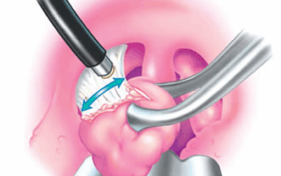 Amigdalectomia com Radiofrequência : O que é e quais são as vantagens?