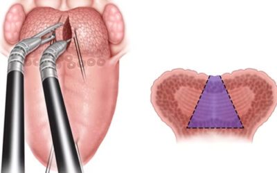 Cirurgia do Ronco e da Apneia do Sono? O que é ? Como funciona ? Quando fazer ?