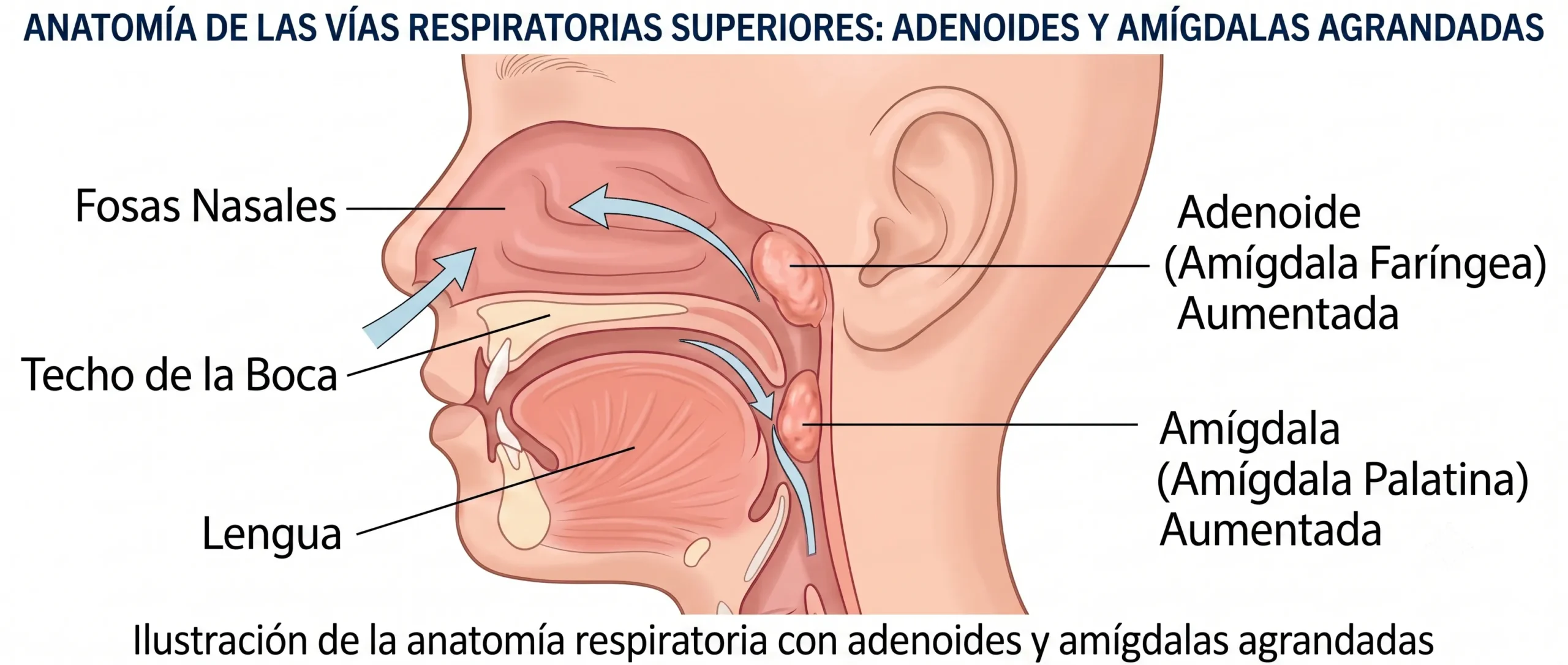 Ilustración de la ubicación de las adenoides en el fondo de la nariz y de las amígdalas en la garganta del niño