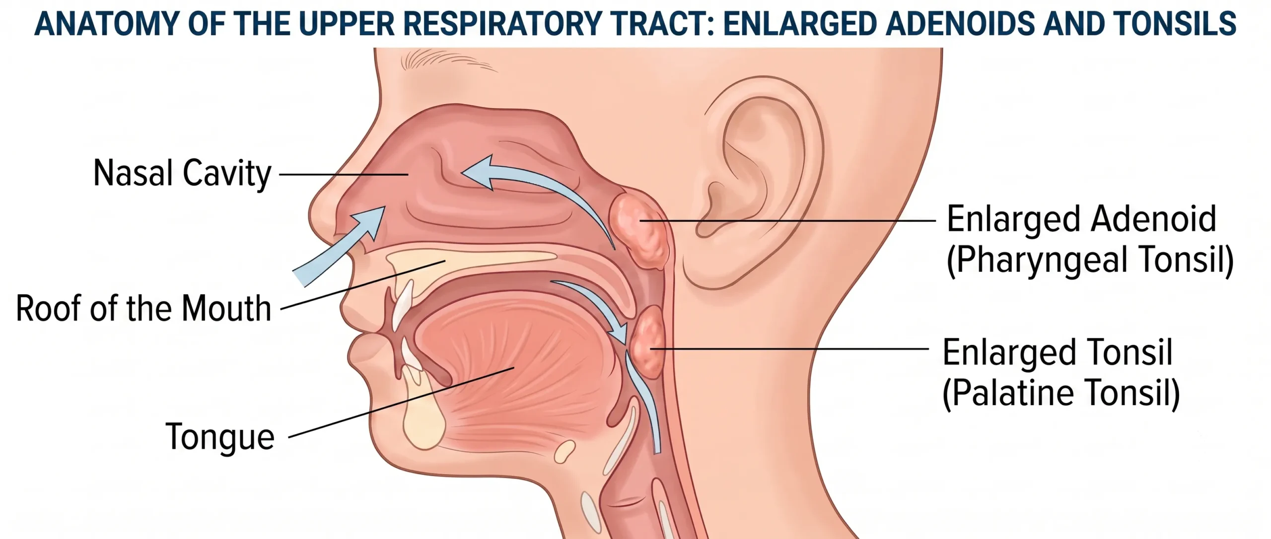 Illustration of the location of the adenoid at the back of the nose and the tonsils in a child’s throat