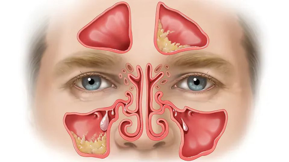 Chronic Sinusitis: Causes, Treatment and Prevention
