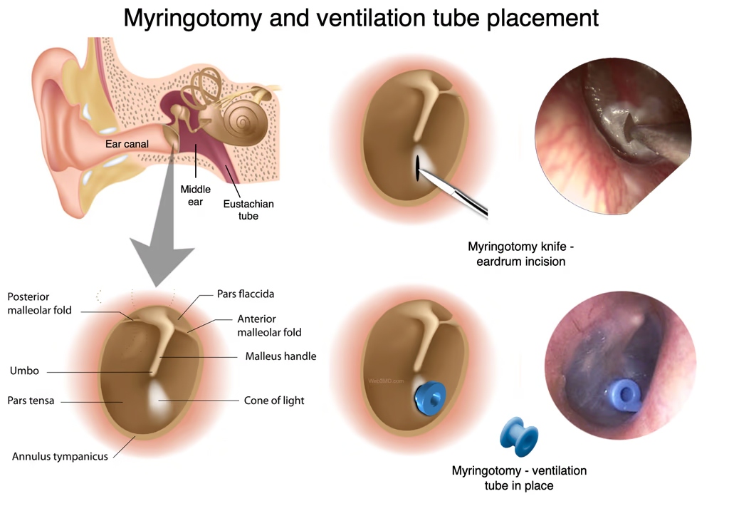 Illustration of a ventilation tube (tympanostomy) placed in a child's eardrum