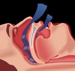 Ilustração da fisiologia da apneia do sono e seus efeitos no corpo