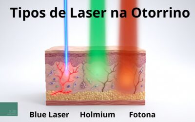 Laser na otorrinolaringologia: como funcionam o holmium, o blue laser e o Fotona