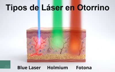 Láser en otorrinolaringología: cómo funcionan el holmio, el blue laser y el Fotona