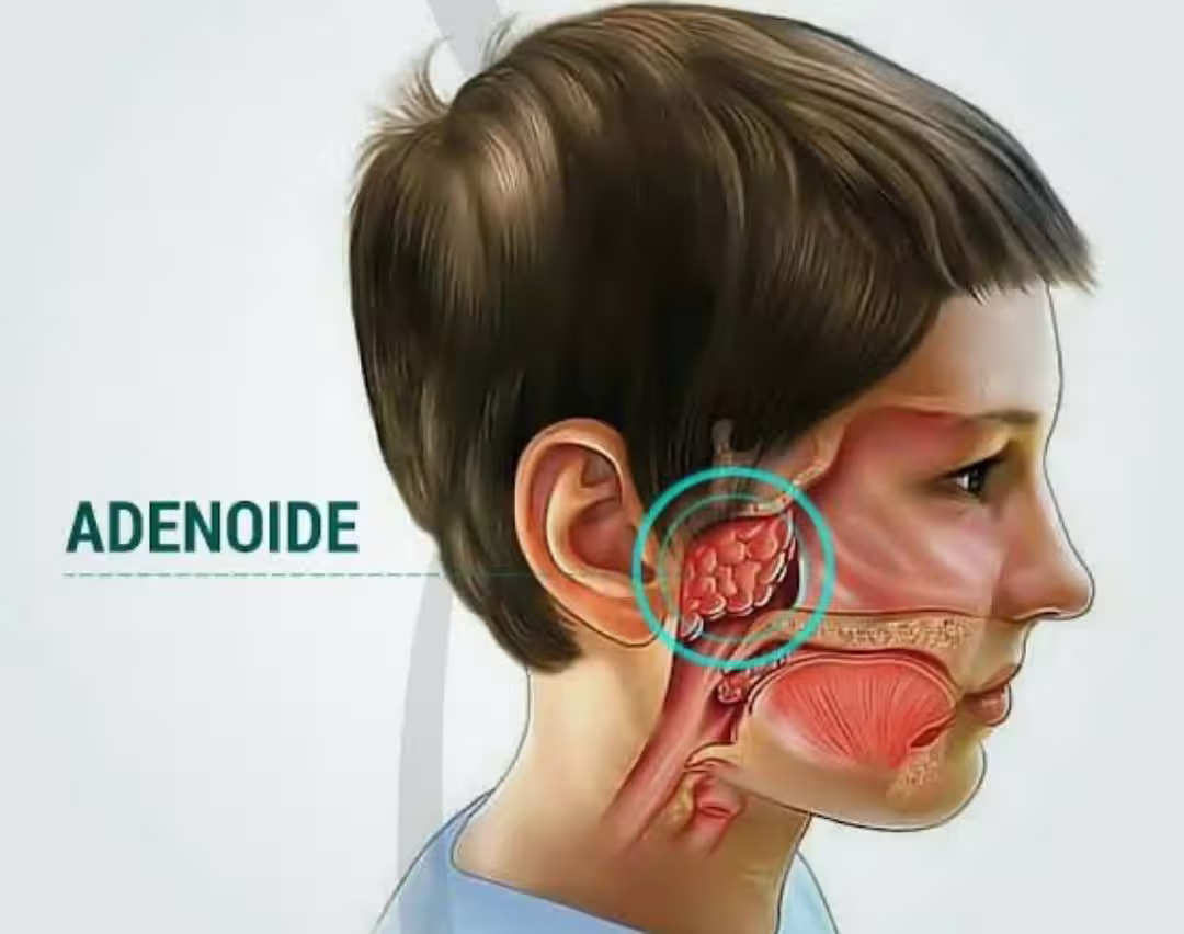 Adenoid and Tonsil Surgery in Children