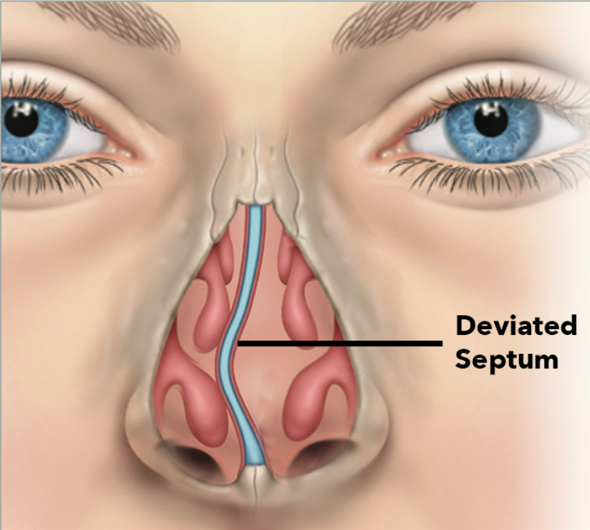 Desvio de septo nasal obstruindo a passagem de ar