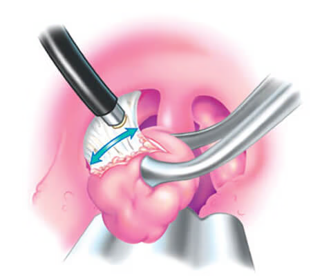 Amigdalectomia com radiofrequência: ilustração do procedimento intracapsular