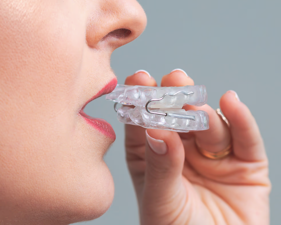 Aparato intraoral abriendo la vía respiratoria de una persona con apnea del sueño