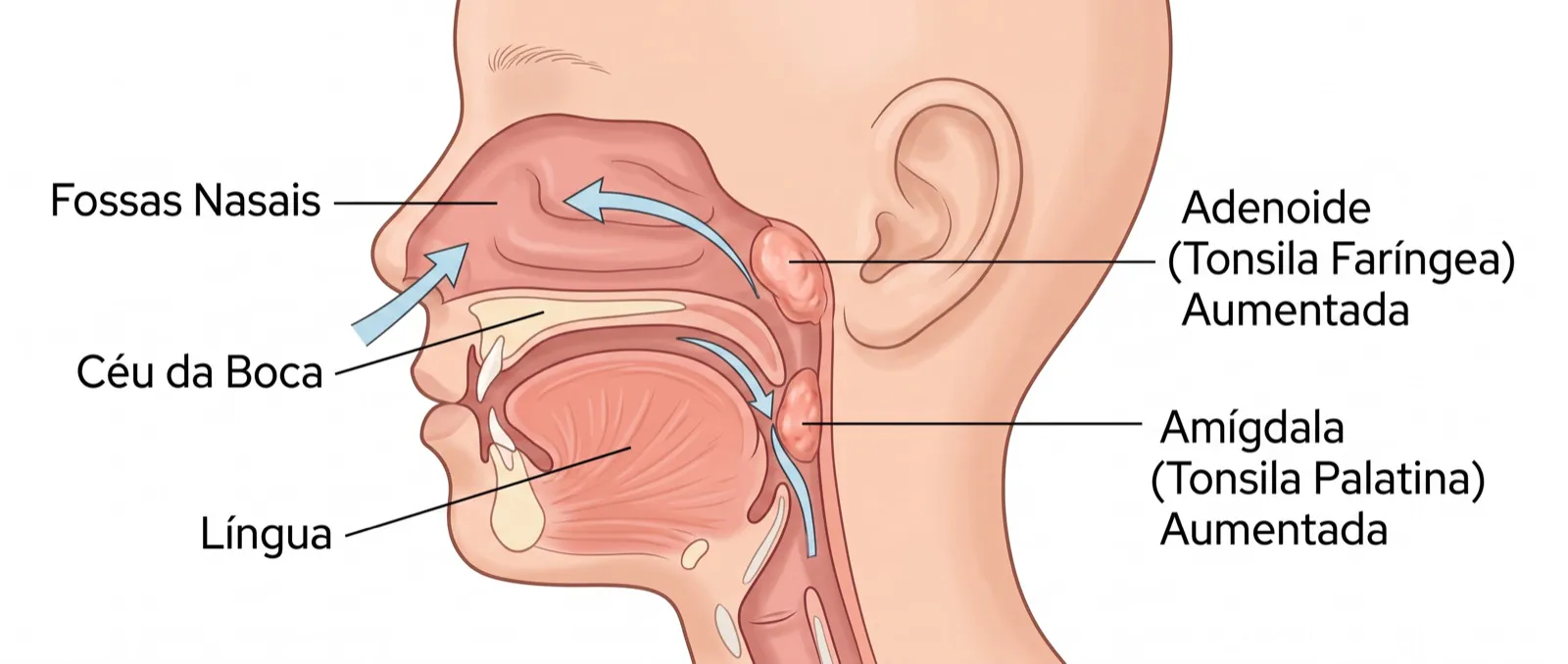 Illustration of the location of the adenoid at the back of the nose and the tonsils in a child’s throat