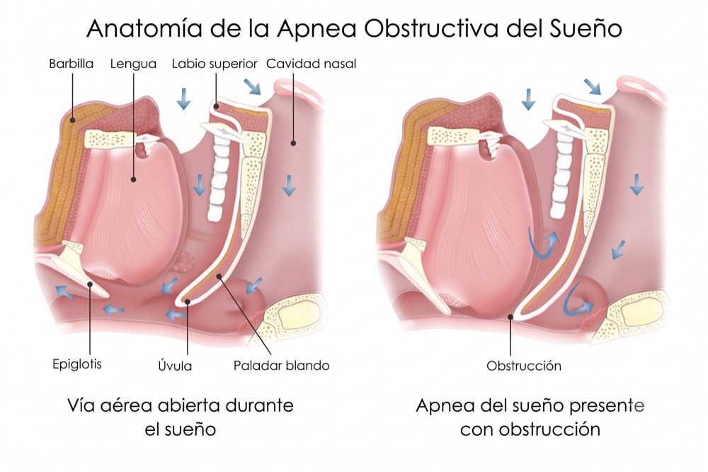 Ilustración que compara la vía aérea abierta durante el sueño y la vía aérea obstruida en la apnea
