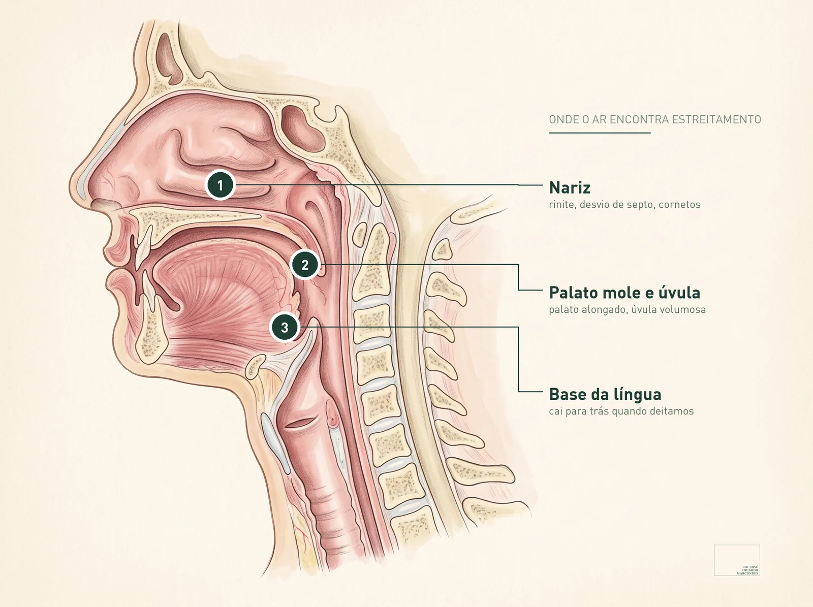Ilustração anatômica em corte sagital mostrando os três pontos onde o ar encontra estreitamento na via aérea: nariz, palato mole e úvula, e base da língua.