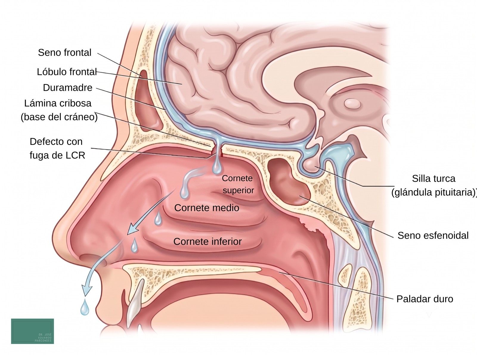Corte sagital anatómico de la fístula de LCR: el líquido cefalorraquídeo escapa por un defecto en la lámina cribosa de la base del cráneo y gotea en la cavidad nasal