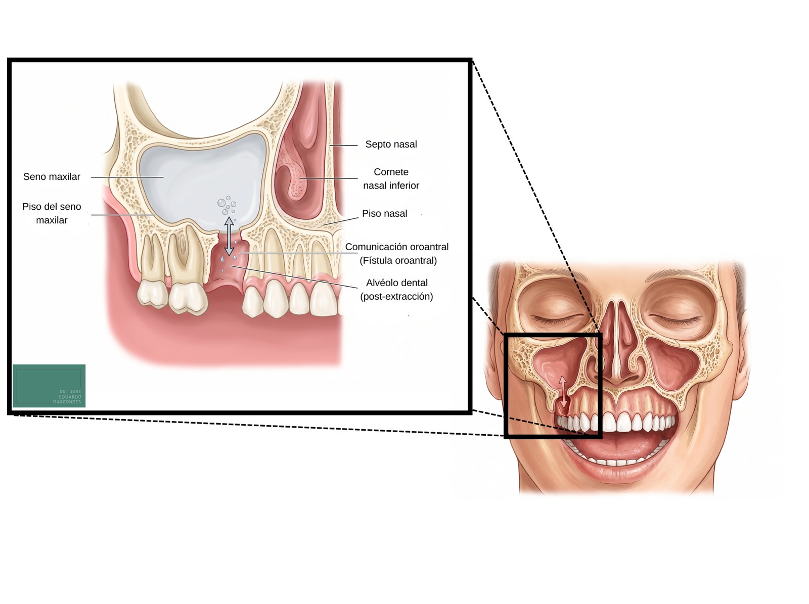 Corte anatómico de la comunicación oroantral (fístula oroantral) entre el seno maxilar y la boca tras la extracción de un molar superior
