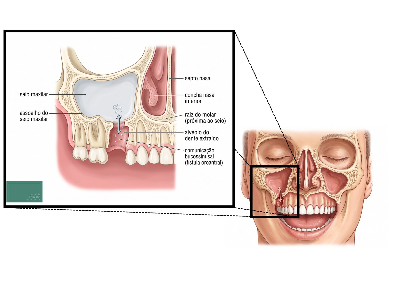 Corte anatômico da comunicação bucossinusal (fístula oroantral) entre o seio maxilar e a boca após extração de molar superior