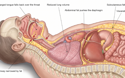 Sleep apnea and obesity: the vicious cycle between weight and sleep (and the role of weight-loss injections)