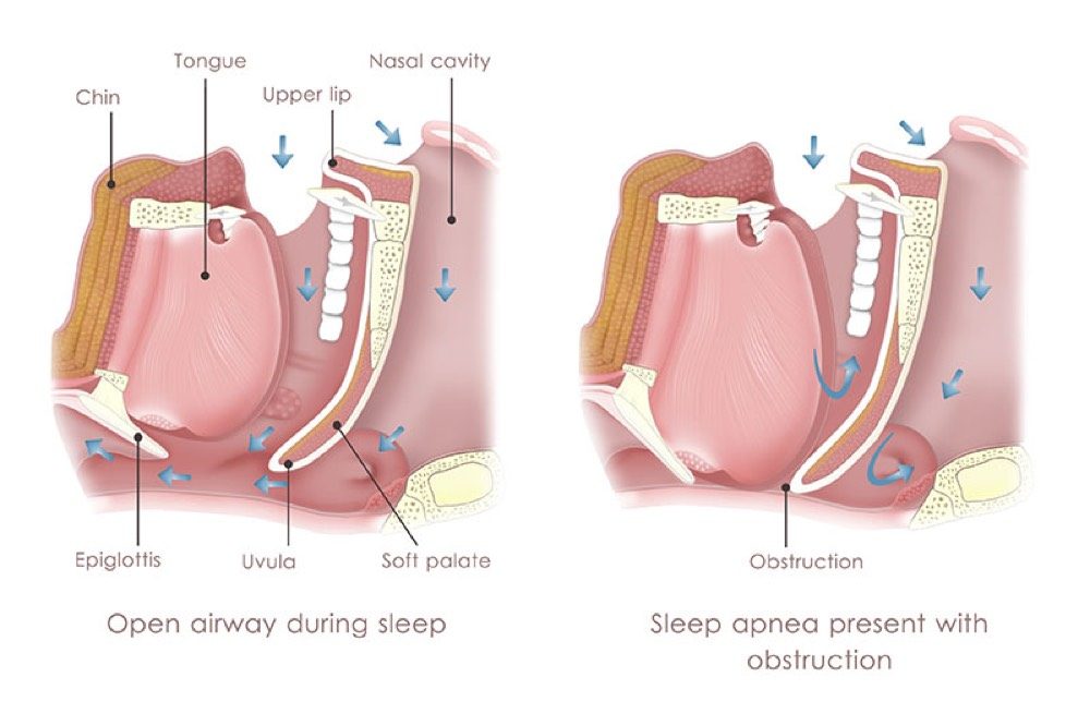 Illustration comparing the open airway during sleep and the obstructed airway in apnea