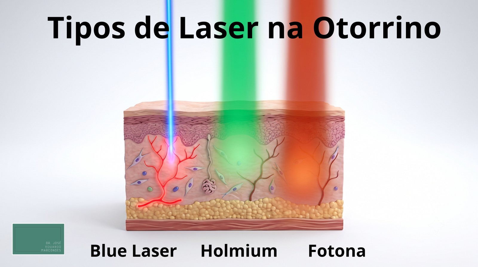 Laser in ENT: how the holmium, blue laser, and Fotona work