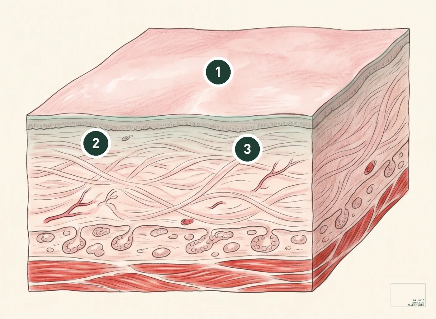 Ilustração de um bloco de tecido do palato mole com as camadas de cima destacadas em verde: o calor controlado do laser, sem corte, contrai as fibras de colágeno e estimula a produção de colágeno novo