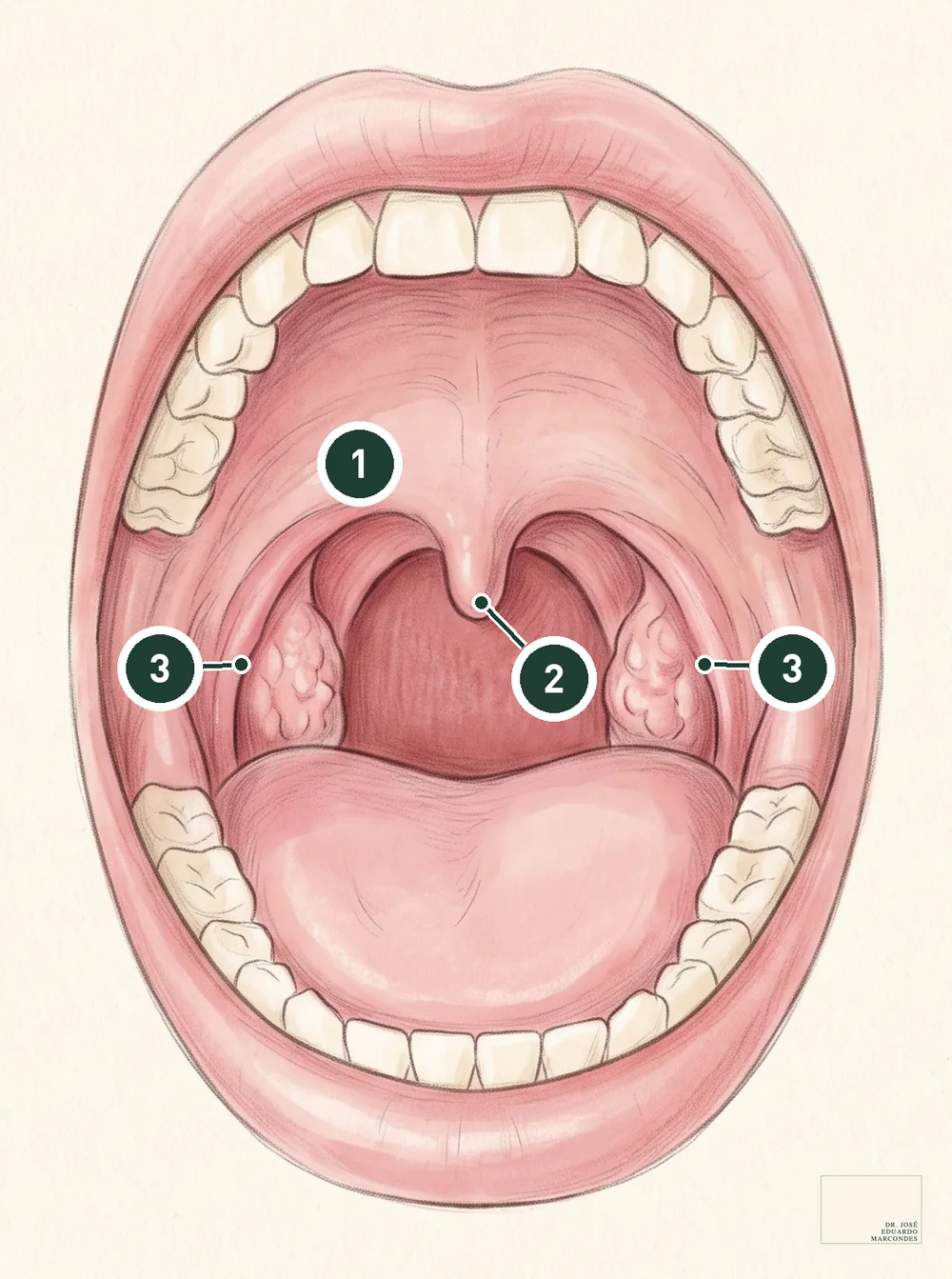 Ilustração anatômica da boca aberta com três pontos numerados: o palato mole, a úvula e o pilar anterior dos dois lados, os tecidos onde o laser é aplicado